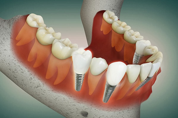 Multiple Implants