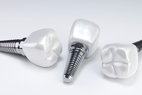 Same Day Implants